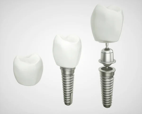 Implante Dental Desmontado Renderizado —  Fotos de Stock