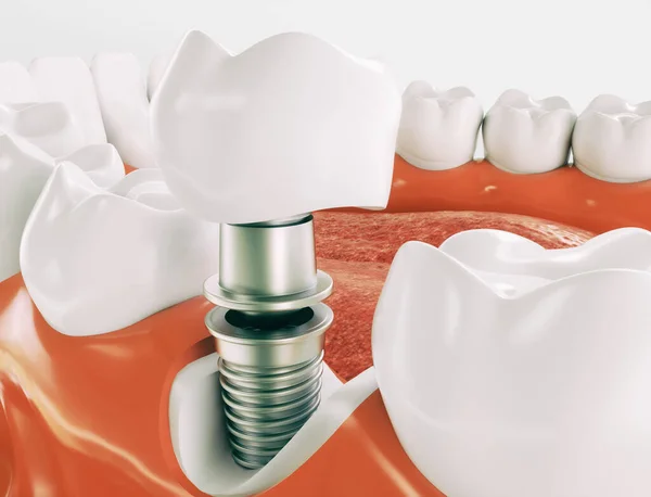 Implante Dental Ejemplo Modelo Mandíbula —  Fotos de Stock