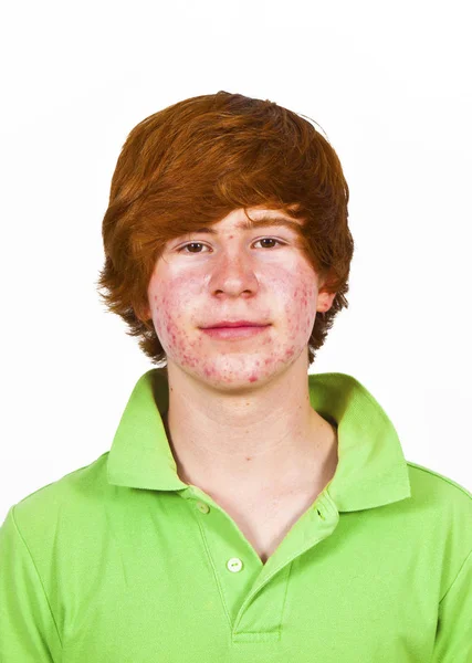 Attractive Boy Puberty Red Hair Stock Photo