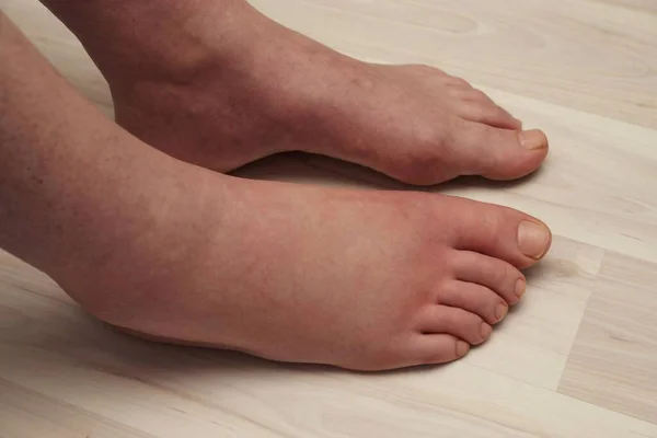 Επώδυνη Αλλεργική Αντίδραση Στο Πόδι Λόγω Τσίμπημα Σφήκας — Φωτογραφία Αρχείου