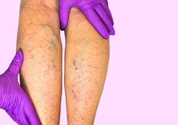 静脈不全の疑いがあるため 下肢血管検査 ピンクの背景の女性の足 — ストック写真