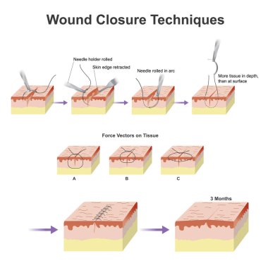 A wound is a type of injury which happens relatively quickly in which skin is torn, cut, or punctured (an open wound),or where blunt force trauma causes a contusion. clipart