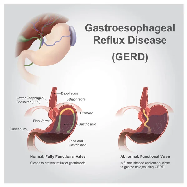 胃食管反流病 Gastroesophageal Reflux Disease 胃反流病 又称胃反流病 Acid Reflux 是一种长期的疾病 其症状或并发症会导致胃内容物恢复到食管中 — 图库照片