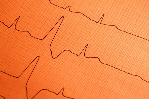 Cardiologia Del Battito Cardiaco Ecg Servizio Ambulanza — Foto Stock