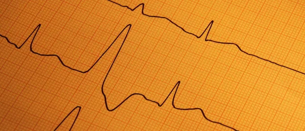 Cardiologia Del Battito Cardiaco Ecg Servizio Ambulanza — Foto Stock