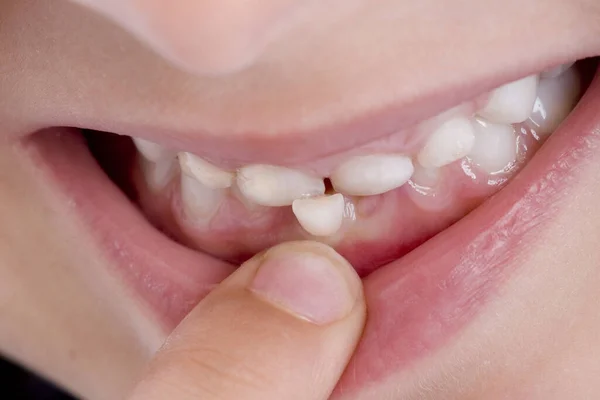 5歳の歯にワッケルデムの歯 ミスター — ストック写真
