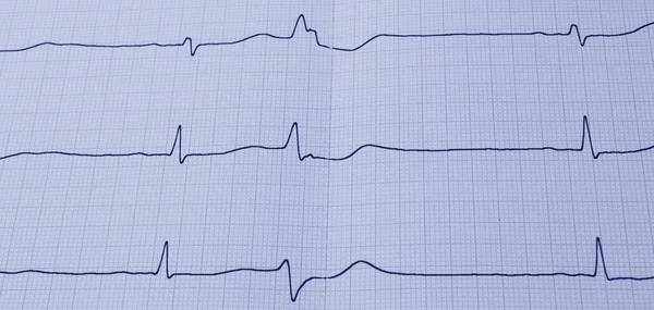 Сердечный Ритм Кардиологии Ecg Скорая Помощь — стоковое фото