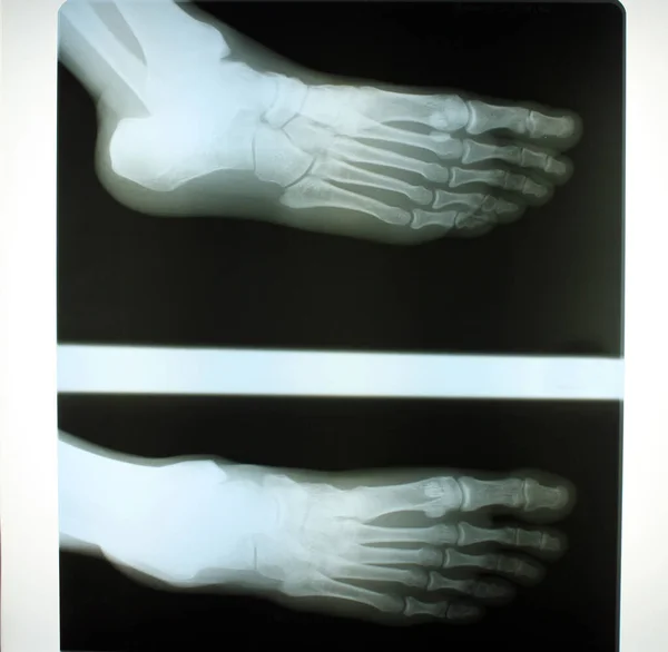 Nsan Ayağının Röntgeni — Stok fotoğraf