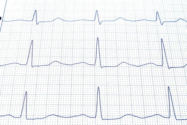 Сердечный Ритм Кардиологии Ecg Скорая Помощь — стоковое фото