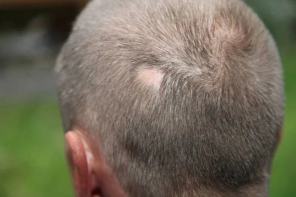Hombre Con Alopecia Areata Parte Posterior — Foto de Stock