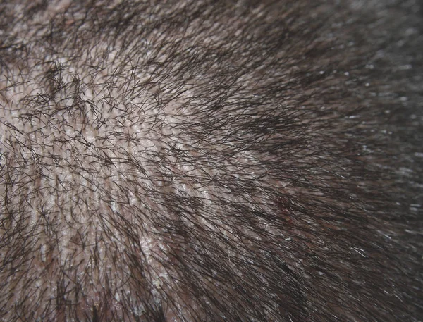 穏やかな乾癬を持つ成人男性の頭の閉鎖 — ストック写真