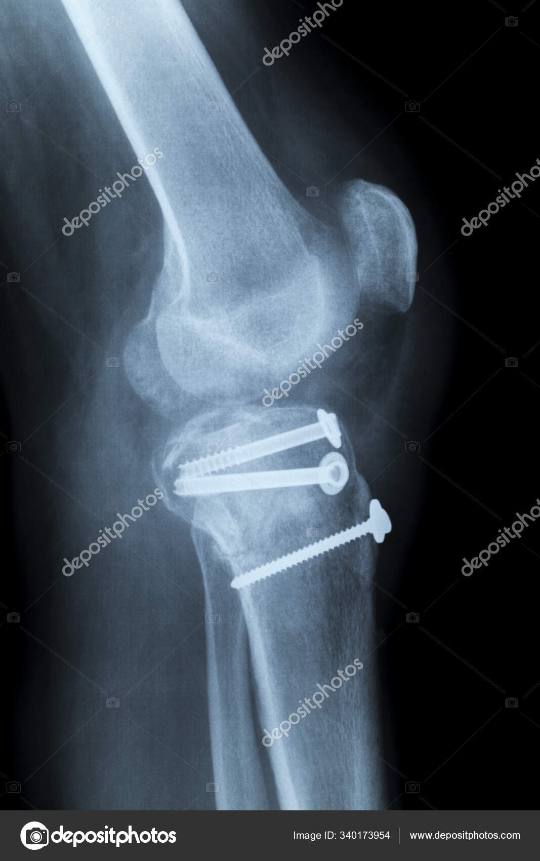 Human Knee Laterally Ray Reduction Means Screws Fracture Stock Photo by