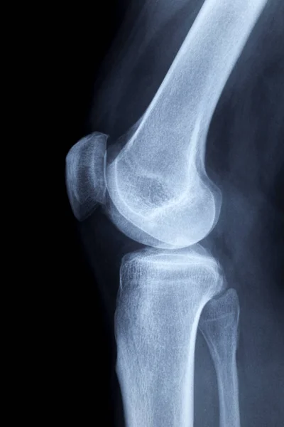 Human Knee Laterally Ray Any Findings — Stok fotoğraf
