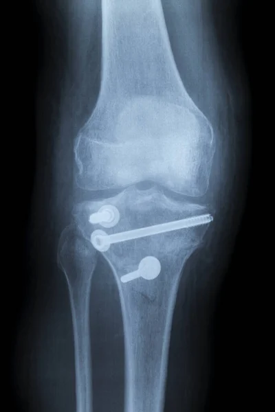 Human Knee Anterior Posterior Radiograph Reduction Means Screws Fracture — Stok fotoğraf