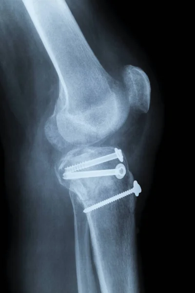 Human Knee Laterally Ray Reduction Means Screws Fracture — Stok fotoğraf