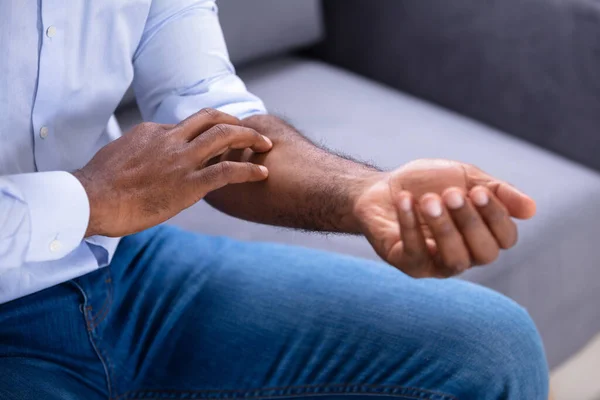 Primer Plano Hombre Africano Rascándose Mano — Foto de Stock