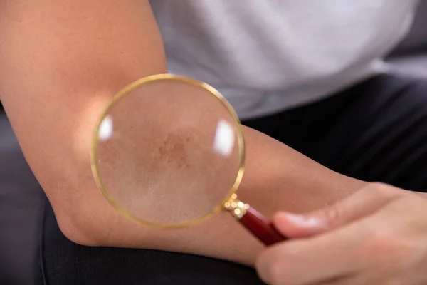 Close Man Examining Mole His Hand Magnifying Glass — Stock Photo, Image