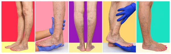 Die Weiblichen Beine Mit Venen Krampfadern Spinne Studio Collage Gefäßuntersuchung — Stockfoto