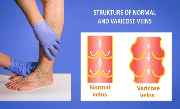 Varicose Veins Female Senior Legs Structure Normal Varicose Veins Copy — Stock Photo, Image