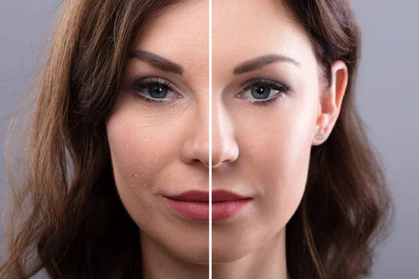 Portrait Of A Young Woman\'s Face Before And After Cosmetic Procedure