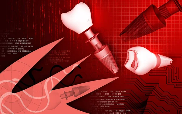 Ilustración Digital Implante Dental Fondo Color — Foto de Stock
