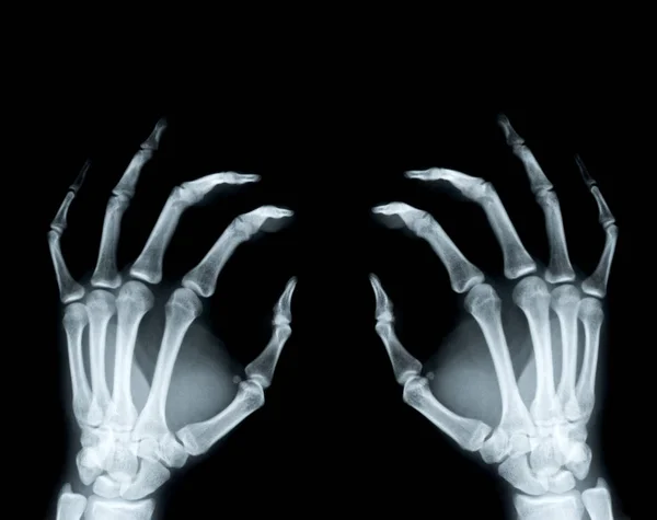 Two Hands Right Left Radiograph — Stock Photo, Image