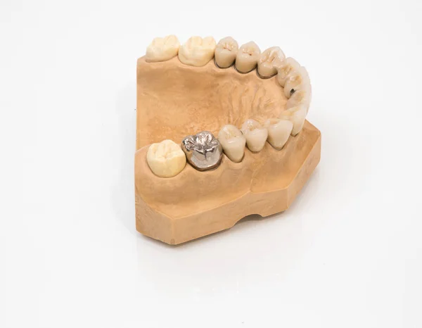 Umělý Zlatý Zub Zubní Plísni — Stock fotografie