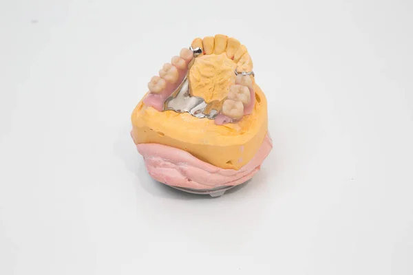 金型上の歯科ブリッジと人工歯 — ストック写真