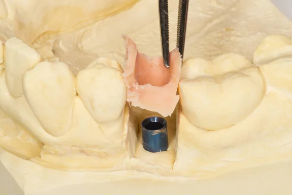 Modelo Implante Con Máscara Gingival — Foto de Stock