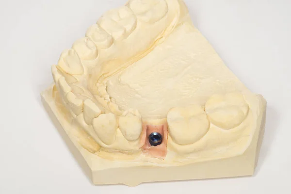 带牙龈面具的种植体模型 — 图库照片
