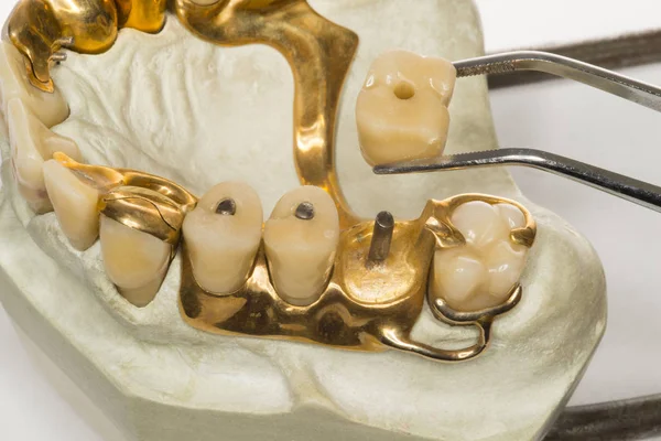 Dentures Platinum Pin Teeth 1950 — Stock Photo, Image