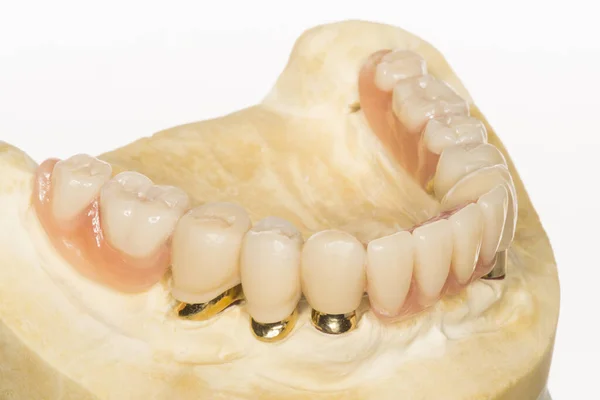 Modelo Dentário Medicina Ortodôntica — Fotografia de Stock