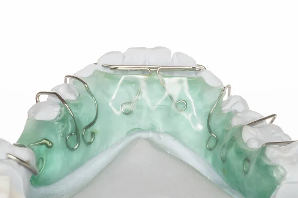 Зубной Имплантат Зубов Кариесом Модель — стоковое фото