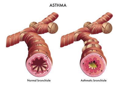 medical illustration of the effects of the Asthma clipart