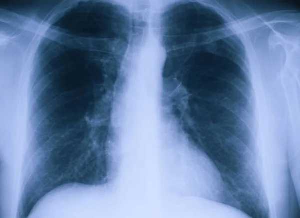 Frontal Radiograph Two Lungs — Stock Photo, Image