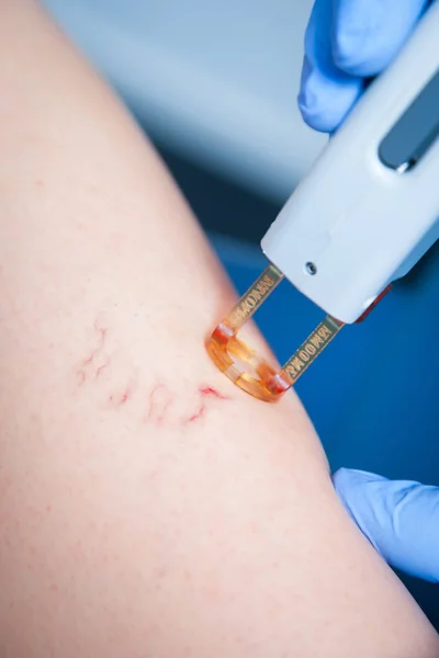 Spider Veins Laser Treatment — Stock Photo, Image