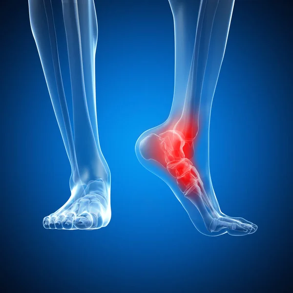 3Dレンダリングされた痛みを伴う足首のイラスト — ストック写真