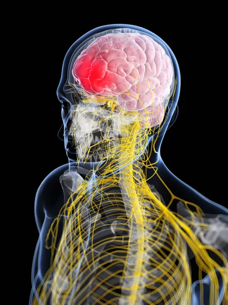Gerenderte Darstellung Des Kopfes Kopfschmerzen — Stockfoto