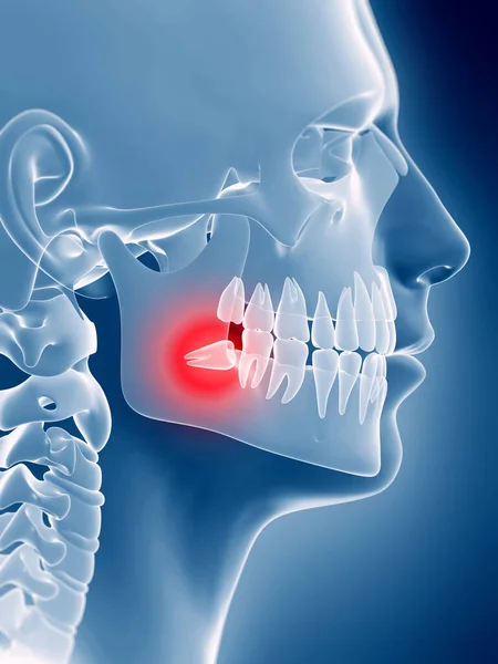 Rendered Illustration Impacted Wisdom Tooth — Stock Photo, Image