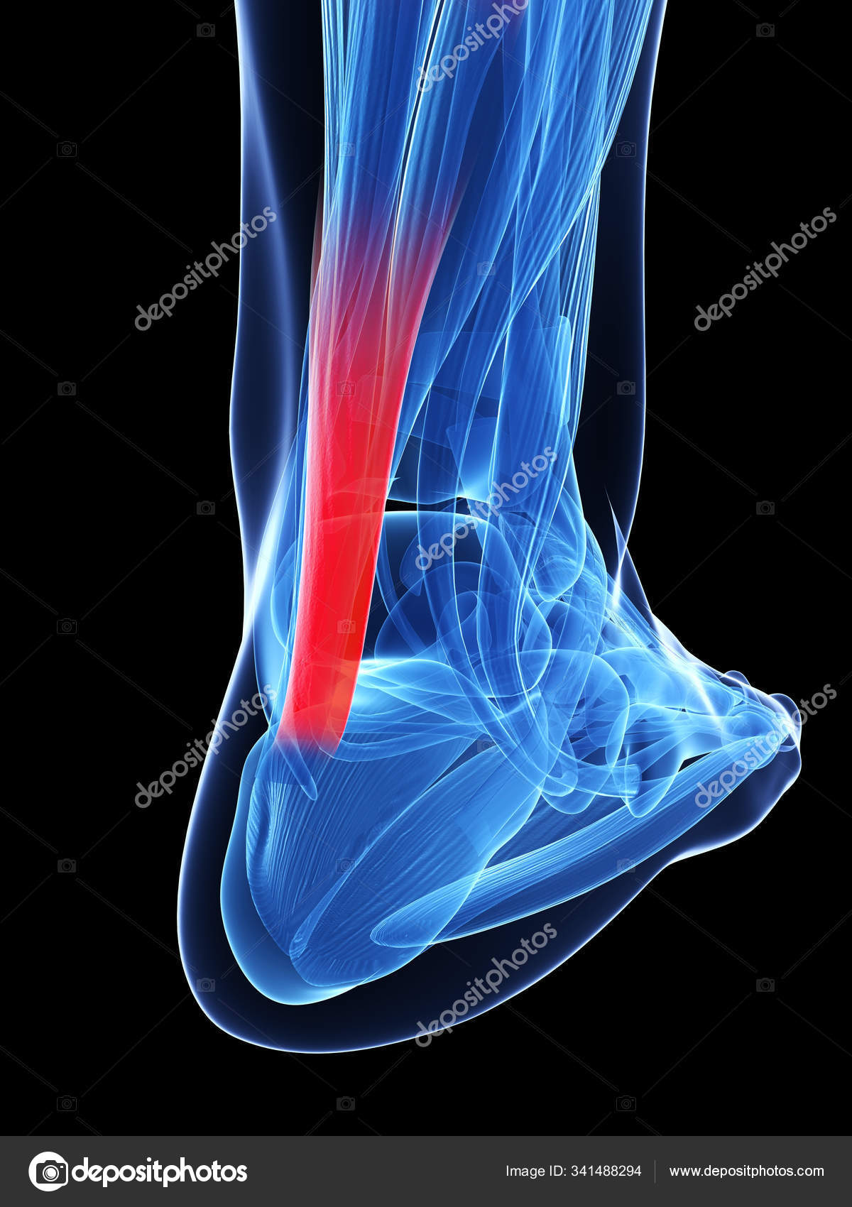 35 Achilles Tendinitis Stock Photos Images Download Achilles Tendinitis Pictures On Depositphotos 35 Achilles Tendinitis Stock Photos Images Download Achilles Tendinitis Pictures On Depositphotos