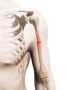 medical illustration of a borken arm bone clipart