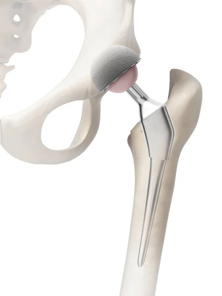 Rendered Illustration Hip Replacement — Stock Photo, Image