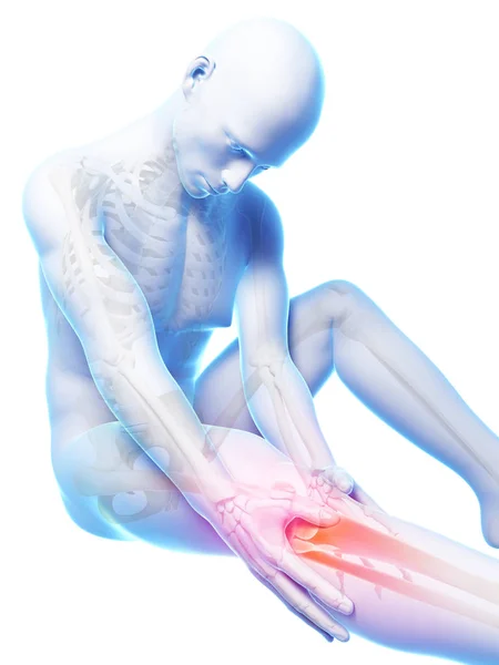 Gerenderte Darstellung Von Schmerzen Knie — Stockfoto