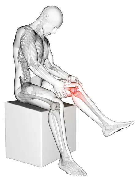 3Dレンダリング医療イラスト 痛み膝 — ストック写真