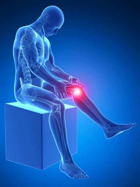 Rendered Medical Illustration Painful Knee — Stock Photo, Image