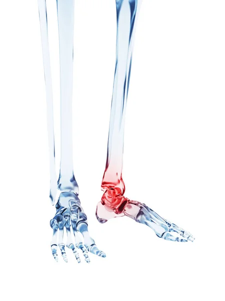 痛みを伴う足首の医療イラスト — ストック写真