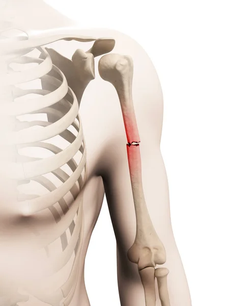 Медицинская Иллюстрация Борной Кости Руки — стоковое фото