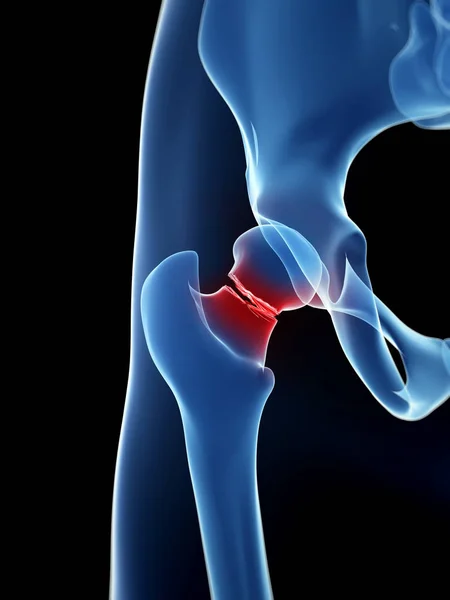 股関節の骨折の医療イラスト — ストック写真
