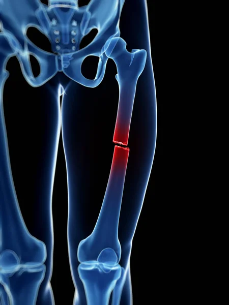Medizinische Illustration Eines Gebrochenen Beinknochens — Stockfoto