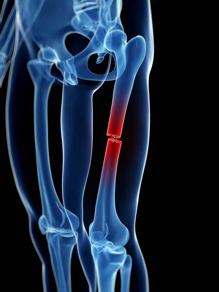 Medical Illustration Broken Leg Bone — Stock Photo, Image